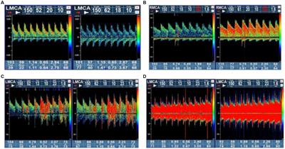 Relationship between right-to-left shunt and white matter lesions in patients with migraine: a single-center study